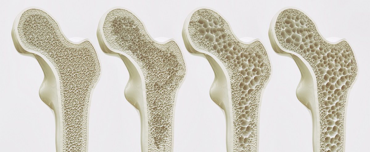Bone density loss for health article on Silver Magazine www.silvermagazine.co.uk