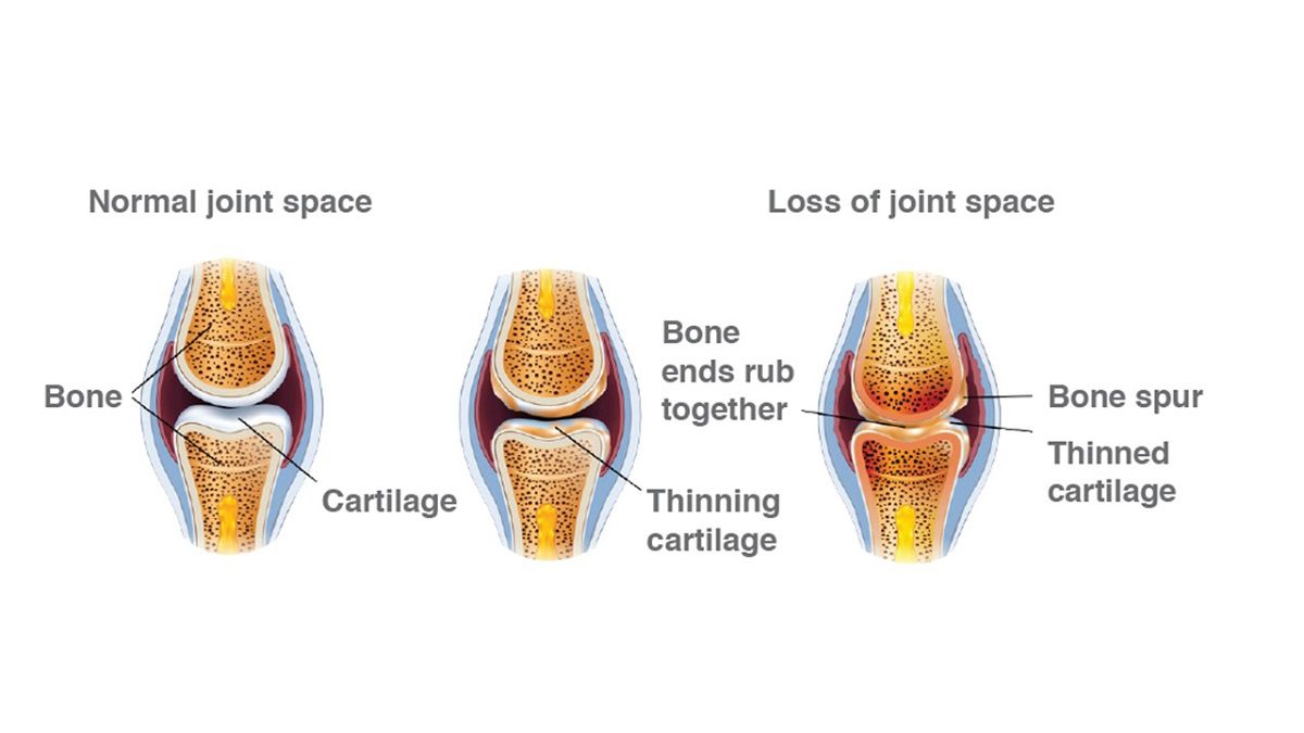 Osteoarthritis cartilage loss in joints for www.silvermagazine.co.uk